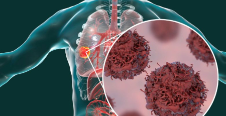Fármaco utilizado para a alergia pode potenciar tratamento de cancro do pulmão