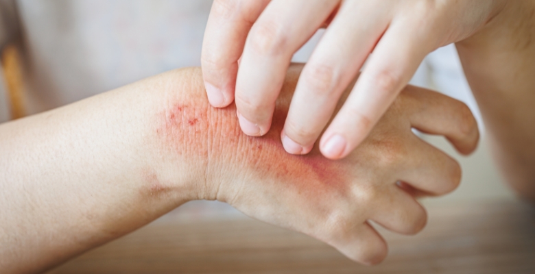 Dermatite alérgica de contacto: a maior causa de eczema crónico das mãos em Portugal