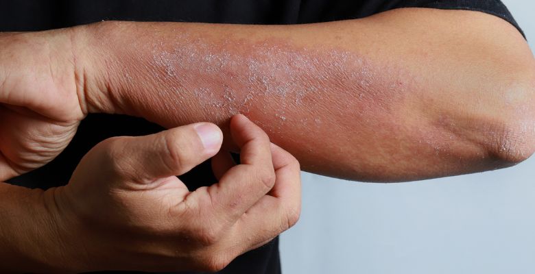 Estudo PROMUSE: baixa utilização de medidas reportadas pelos doentes na dermatite atópica e urticária crónica